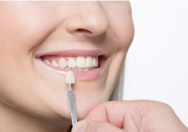 How Much Do Veneers Cost?