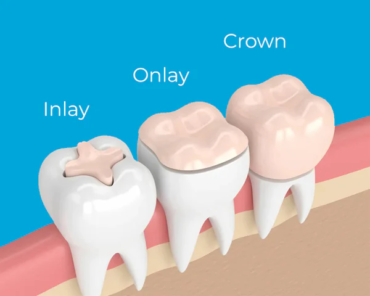 Inlay Or Onlay: Discover Their Differences - Upland Dental Practice