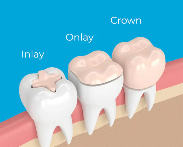 The difference between Inlay, onlay, and a crown