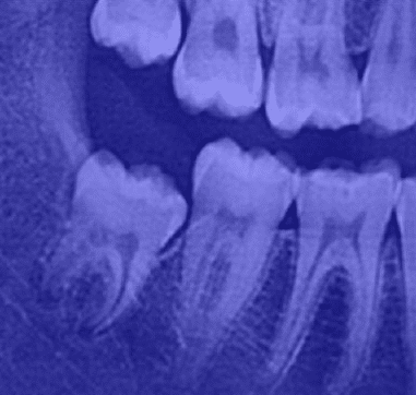 An impacted tooth At an Angle Toward the Next Tooth (Second Molar)