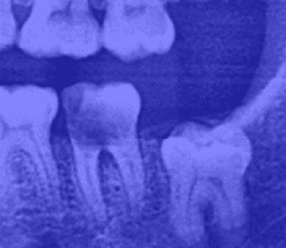 The wisdom tooth grows in the correct vertical direction but doesn’t fully emerge because it’s stuck within the jawbone.