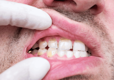 Partial Crown for a Cracked Tooth: Is It Recommended?