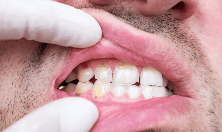 patient with cracked front tooth